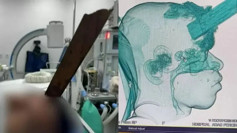  Trabalhador sobrevive após ficar com estaca encravada na cabeça no RJ